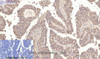 Immunohistochemistry of paraffin-embedded Human lung cancer tissue using CA9 Monoclonal Antibody at dilution of 1:200.