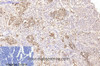Immunohistochemistry of paraffin-embedded Human lung cancer tissue using CD15 Monoclonal Antibody at dilution of 1:200.
