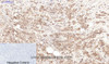 Immunohistochemistry of paraffin-embedded Human breast cancer tissue using LTF Monoclonal Antibody at dilution of 1:200.