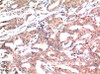 Immunohistochemistry of paraffin-embedded Human breast carcinoma tissue using GSK3 beta Monoclonal Antibody at dilution of 1:200.