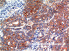 Immunohistochemistry of paraffin-embedded Human stomach carcinoma tissue using GSK3 beta Monoclonal Antibody at dilution of 1:200.