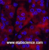 Immunofluorescence analysis of Human stomach cancer tissue using Ubiquitin Monoclonal Antibody at dilution of 1:200.