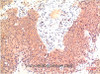 Immunohistochemistry of paraffin-embedded Human colon carcinoma tissue using Epsilon Tubulin Monoclonal Antibody at dilution of 1:200.