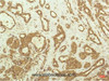 Immunohistochemistry of paraffin-embedded Human breast carcinoma tissue using p70 S6 kinase alpha Monoclonal Antibody at dilution of 1:200.