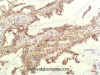 Immunohistochemistry of paraffin-embedded Human lung carcinoma tissue using IL8 Monoclonal Antibody at dilution of 1:200.