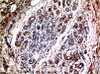 Immunohistochemistry of paraffin-embedded Human breast carcinoma tissue using AKT1 Monoclonal Antibody at dilution of 1:200.