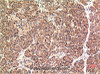 Immunohistochemistry of paraffin-embedded Human pancreas carcinoma tissue using CHOP Monoclonal Antibody at dilution of 1:200.