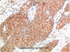Immunohistochemistry of paraffin-embedded Human breast carcinoma tissue using ATM Monoclonal Antibody at dilution of 1:200.