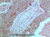 Immunohistochemistry of paraffin-embedded Human breast carcinoma tissue using JAK2 Monoclonal Antibody at dilution of 1:200.