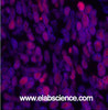 Immunofluorescence analysis of Human lung cancer tissue using Acetyl-Histone H3 (Lys9) Polyclonal Antibody at dilution of 1:200.