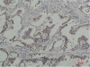 Immunohistochemistry of paraffin-embedded Human breast carcinoma tissue with Phosphotyrosine Monoclonal Antibody at dilution of 1:200