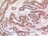 Immunohistochemistry of paraffin-embedded Human breast carcinoma tissue using Phospho-AKT1 (Ser473) Monoclonal Antibody at dilution of 1:200
