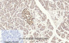 Immunohistochemistry of paraffin-embedded Human stomach cancer tissue using Cleaved-CASP3 p17 (D175) Polyclonal Antibody at dilution of 1:200.