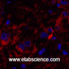 Immunofluorescence analysis of Human breast cancer tissue using Cleaved-CASP8 (D384) Polyclonal Antibody at dilution of 1:200.