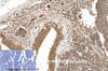 Immunohistochemistry of paraffin-embedded Human lung cancer tissue using Cleaved-PARP1 (D214) Polyclonal Antibody at dilution of 1:200.