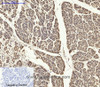 Immunohistochemistry of paraffin-embedded Human stomach cancer tissue using PYCARD Polyclonal Antibody at dilution of 1:200.