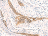 Immunohistochemistry of paraffin-embedded Human esophagus cancer tissue  using HSPA4L Polyclonal Antibody at dilution of 1:30(×200)
