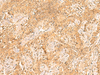 Immunohistochemistry of paraffin-embedded Human ovarian cancer tissue  using TRMT112 Polyclonal Antibody at dilution of 1:30(×200)