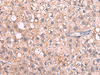 Immunohistochemistry of paraffin-embedded Human liver cancer tissue  using JAZF1 Polyclonal Antibody at dilution of 1:55(×200)