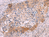 Immunohistochemistry of paraffin-embedded Human cervical cancer tissue  using GRIK4 Polyclonal Antibody at dilution of 1:50(×200)