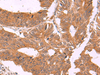 Immunohistochemistry of paraffin-embedded Human colorectal cancer tissue  using ZBTB33 Polyclonal Antibody at dilution of 1:30(×200)