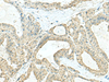Immunohistochemistry of paraffin-embedded Human thyroid cancer tissue  using CD9 Polyclonal Antibody at dilution of 1:40(×200)