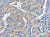 Immunohistochemistry of paraffin-embedded Human thyroid cancer tissue  using RXFP4 Polyclonal Antibody at dilution of 1:40(×200)