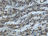 Immunohistochemistry of paraffin-embedded Human liver cancer tissue  using CUL5 Polyclonal Antibody at dilution of 1:55(×200)