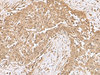 Immunohistochemistry of paraffin-embedded Human esophagus cancer tissue  using RCHY1 Polyclonal Antibody at dilution of 1:50(×200)