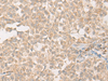 Immunohistochemistry of paraffin-embedded Human ovarian cancer tissue  using PPM1D Polyclonal Antibody at dilution of 1:60(×200)