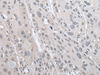 Immunohistochemistry of paraffin-embedded Human esophagus cancer tissue  using PRAME Polyclonal Antibody at dilution of 1:65(×200)