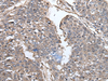 Immunohistochemistry of paraffin-embedded Human liver cancer tissue  using PRUNE Polyclonal Antibody at dilution of 1:40(×200)