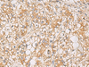 Immunohistochemistry of paraffin-embedded Human liver cancer tissue  using PTPRN Polyclonal Antibody at dilution of 1:55(×200)