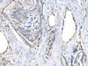 Immunohistochemistry of paraffin-embedded Human thyroid cancer tissue  using RASSF8 Polyclonal Antibody at dilution of 1:55(×200)