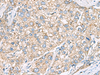 Immunohistochemistry of paraffin-embedded Human liver cancer tissue  using SHC3 Polyclonal Antibody at dilution of 1:40(×200)