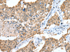 Immunohistochemistry of paraffin-embedded Human lung cancer tissue  using SPRY4 Polyclonal Antibody at dilution of 1:25(×200)