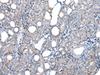 Immunohistochemistry of paraffin-embedded Human thyroid cancer tissue  using FKBPL Polyclonal Antibody at dilution of 1:50(×200)