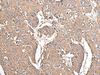 Immunohistochemistry of paraffin-embedded Human prost at e cancer tissue  using KRT73 Polyclonal Antibody at dilution of 1:55(×200)