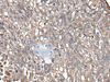 Immunohistochemistry of paraffin-embedded Human lung cancer tissue  using KRT73 Polyclonal Antibody at dilution of 1:55(×200)