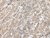 Immunohistochemistry of paraffin-embedded Human colorectal cancer tissue  using HIF1A Polyclonal Antibody at dilution of 1:45(×200)