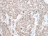 Immunohistochemistry of paraffin-embedded Human prost ate cancer tissue  using HNRNPH2 Polyclonal Antibody at dilution of 1:40(×200)