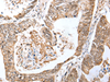 Immunohistochemistry of paraffin-embedded Human colorectal cancer tissue  using LRRC19 Polyclonal Antibody at dilution of 1:30(×200)