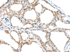 Immunohistochemistry of paraffin-embedded Human thyroid cancer tissue  using SPACA3 Polyclonal Antibody at dilution of 1:45(×200)