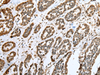 Immunohistochemistry of paraffin-embedded Human esophagus cancer tissue  using CNPY2 Polyclonal Antibody at dilution of 1:25(×200)