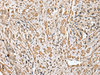 Immunohistochemistry of paraffin-embedded Human prost ate cancer tissue  using CNPY2 Polyclonal Antibody at dilution of 1:25(×200)