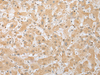 Immunohistochemistry of paraffin-embedded Human liver cancer tissue  using DHRSX Polyclonal Antibody at dilution of 1:30(×200)