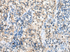 Immunohistochemistry of paraffin-embedded Human lung cancer tissue  using DHRSX Polyclonal Antibody at dilution of 1:30(×200)