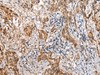 Immunohistochemistry of paraffin-embedded Human lung cancer tissue  using LYPD4 Polyclonal Antibody at dilution of 1:25(×200)