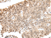 Immunohistochemistry of paraffin-embedded Human colorectal cancer tissue  using ZNF410 Polyclonal Antibody at dilution of 1:40(×200)