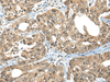 Immunohistochemistry of paraffin-embedded Human gastric cancer tissue  using ZNF468 Polyclonal Antibody at dilution of 1:35(×200)
